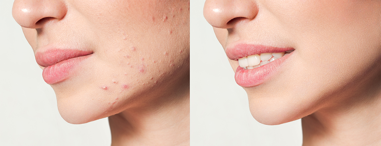 Acne Scar Treatment